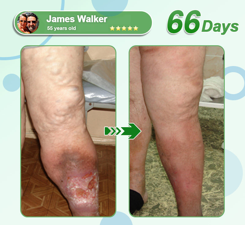 [See results in 7 days]🔔Croaie® Nano Microneedle Patch SMGT-GLP-1 & Matrixyl™  3000（Painless, long-lasting, addressing diabetes, obesity, and cardiovascular diseases）💚