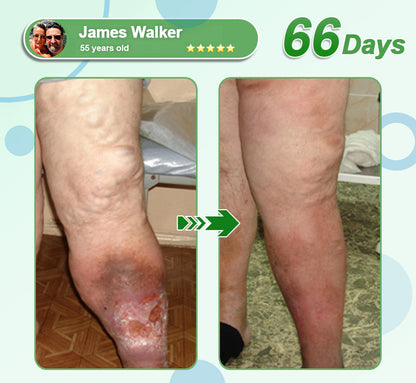[See results in 7 days]🔔Croaie® Nano Microneedle Patch SMGT-GLP-1 & Matrixyl™  3000（Painless, long-lasting, addressing diabetes, obesity, and cardiovascular diseases）💚